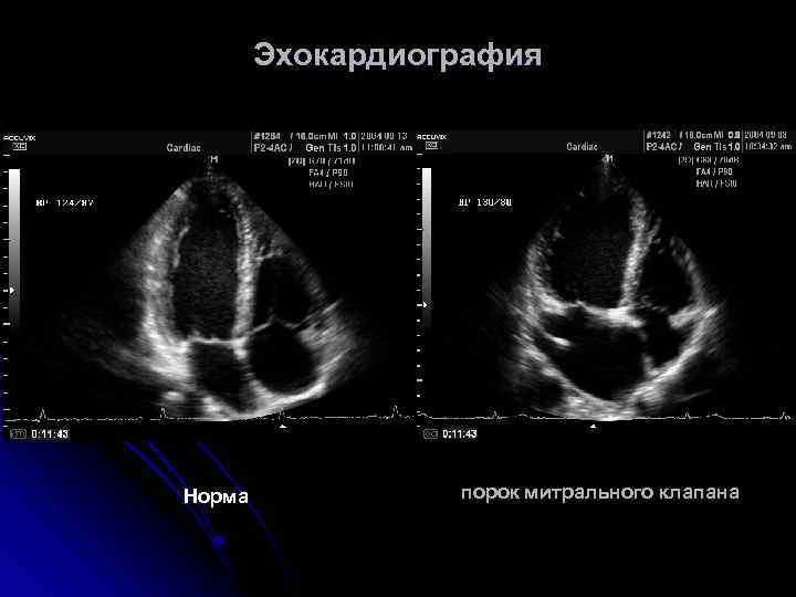 Эхокардиография Норма порок митрального клапана 