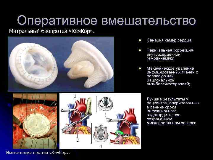 Оперативное вмешательство Митральный биопротез «Кем. Кор» . l l Радикальная коррекция внутрисердечной гемодинамики l