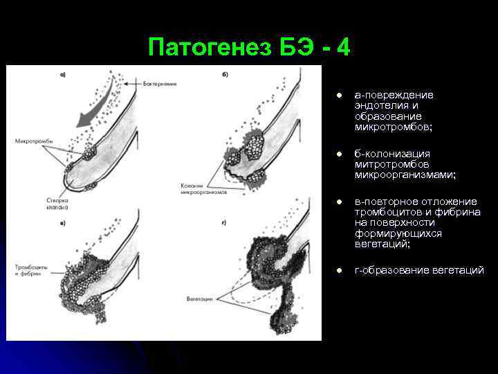 Патогенез БЭ - 4 l а-повреждение эндотелия и образование микротромбов; l б-колонизация митротромбов микроорганизмами;
