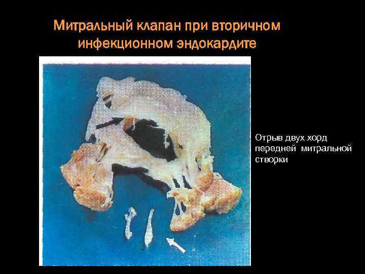 Митральный клапан при вторичном инфекционном эндокардите Отрыв двух хорд передней митральной створки 