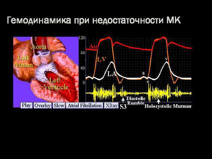 Гемодинамика при недостаточности МК 