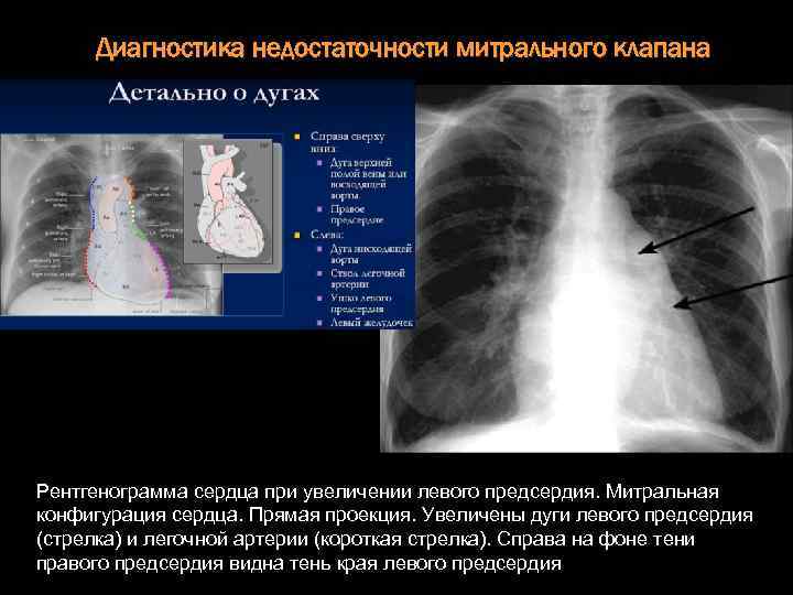 Диагностика недостаточности митрального клапана Рентгенограмма сердца при увеличении левого предсердия. Митральная конфигурация сердца. Прямая