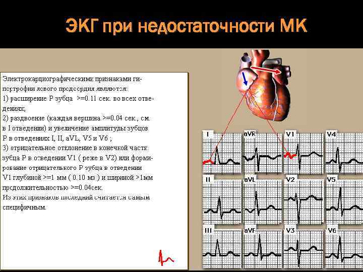 ЭКГ при недостаточности МК 