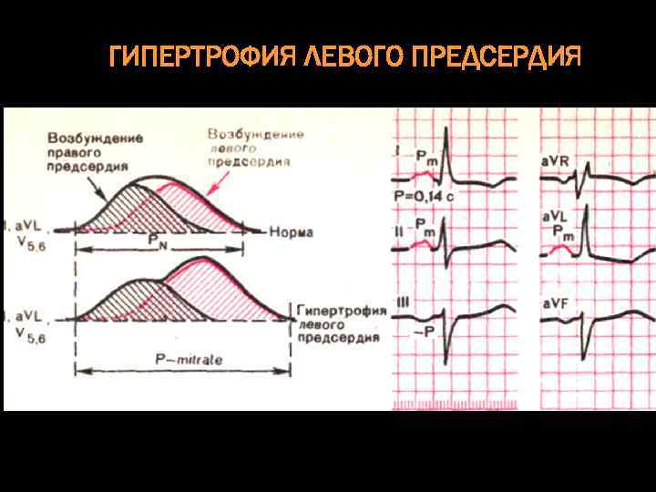 ГИПЕРТРОФИЯ ЛЕВОГО ПРЕДСЕРДИЯ 