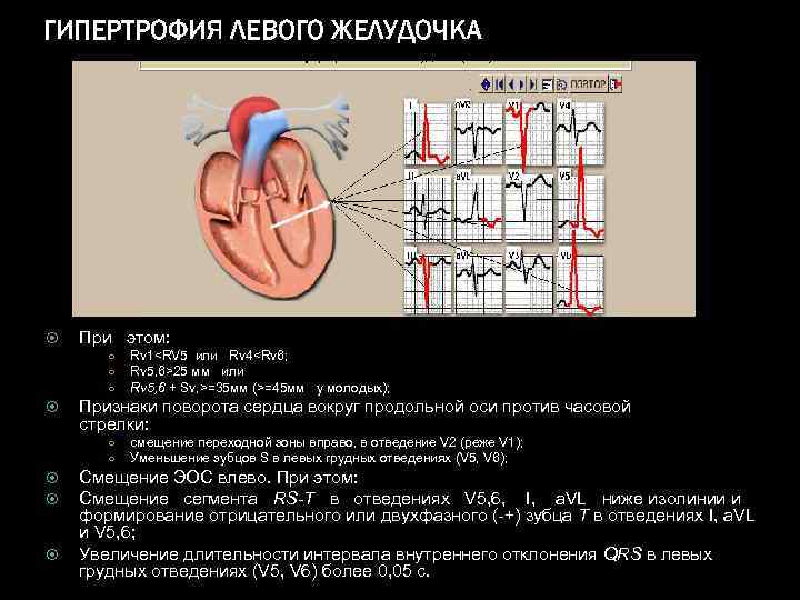ГИПЕРТРОФИЯ ЛЕВОГО ЖЕЛУДОЧКА При этом: ○ ○ ○ Признаки поворота сердца вокруг продольной оси