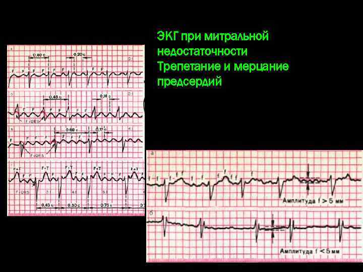 ЭКГ при митральной недостаточности Трепетание и мерцание предсердий 