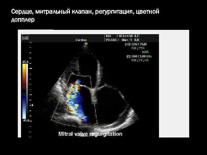 Сердце, митральный клапан, регургитация, цветной допплер 