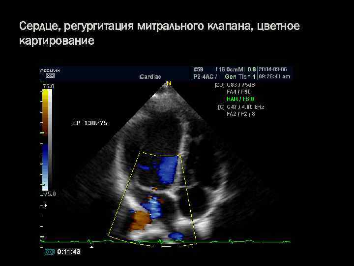 Сердце, регургитация митрального клапана, цветное картирование 