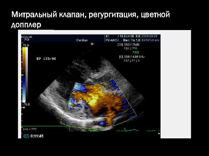 Митральный клапан, регургитация, цветной допплер 