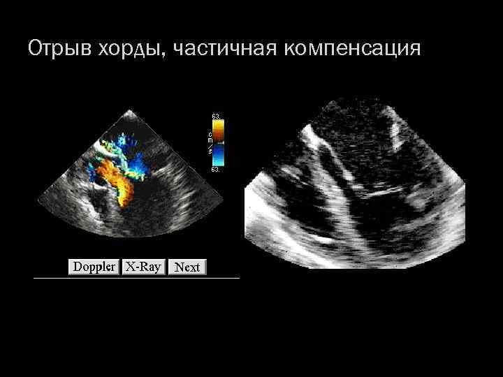 Отрыв хорды, частичная компенсация 