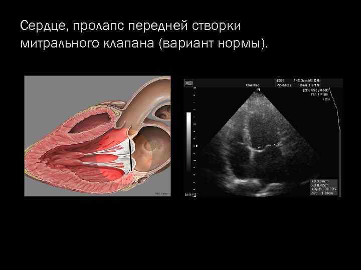 Сердце, пролапс передней створки митрального клапана (вариант нормы). 