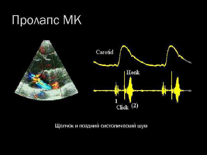 Пролапс МК Щелчок и поздний систолический шум 
