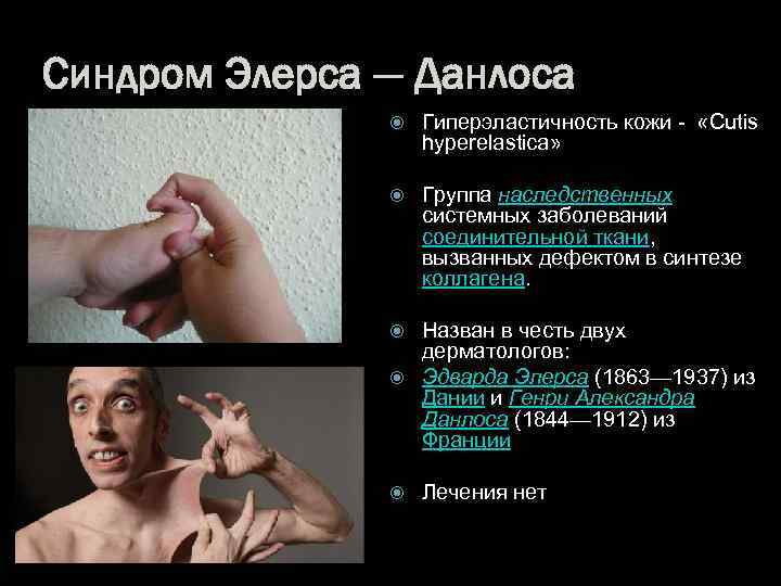 Синдром Элерса — Данлоса Гиперэластичность кожи - «Cutis hyperelastica» Группа наследственных системных заболеваний соединительной