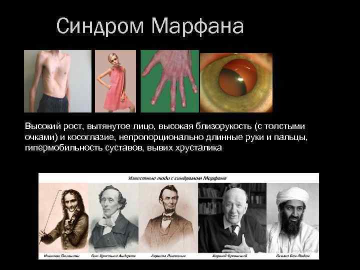 Синдром Марфана Высокий рост, вытянутое лицо, высокая близорукость (с толстыми очками) и косоглазие, непропорционально