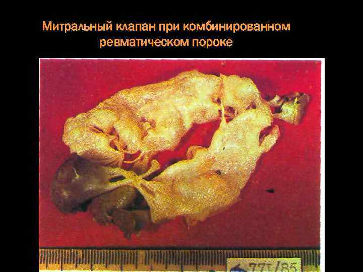 Митральный клапан при комбинированном ревматическом пороке 