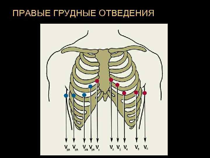 ПРАВЫЕ ГРУДНЫЕ ОТВЕДЕНИЯ 