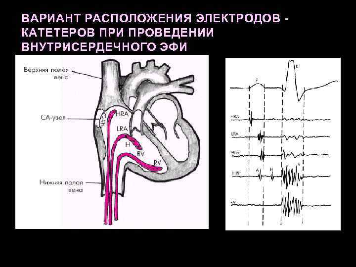 ВАРИАНТ РАСПОЛОЖЕНИЯ ЭЛЕКТРОДОВ КАТЕТЕРОВ ПРИ ПРОВЕДЕНИИ ВНУТРИСЕРДЕЧНОГО ЭФИ 