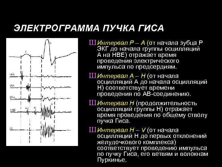 ЭЛЕКТРОГРАММА ПУЧКА ГИСА Ш Интервал Р – А (от начала зубца Р ЭКГ до