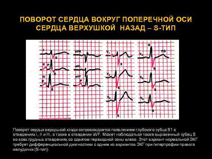 ПОВОРОТ СЕРДЦА ВОКРУГ ПОПЕРЕЧНОЙ ОСИ СЕРДЦА ВЕРХУШКОЙ НАЗАД – S-ТИП Поворот сердца верхушкой кзади