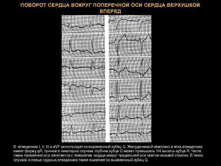 ПОВОРОТ СЕРДЦА ВОКРУГ ПОПЕРЕЧНОЙ ОСИ СЕРДЦА ВЕРХУШКОЙ ВПЕРЕД В отведениях I, III и a.
