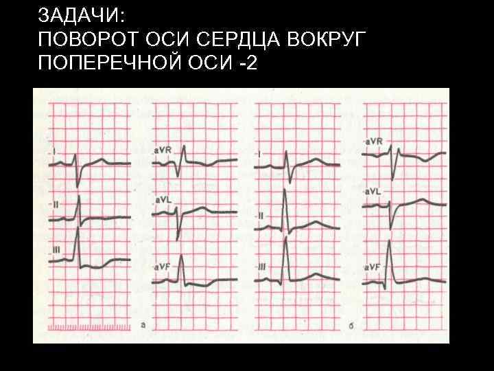 ЗАДАЧИ: ПОВОРОТ ОСИ СЕРДЦА ВОКРУГ ПОПЕРЕЧНОЙ ОСИ -2 