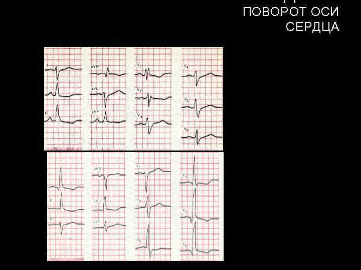 ПОВОРОТ ОСИ СЕРДЦА 