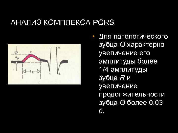 АНАЛИЗ КОМПЛЕКСА PQRS • Для патологического зубца Q характерно увеличение его амплитуды более 1/4