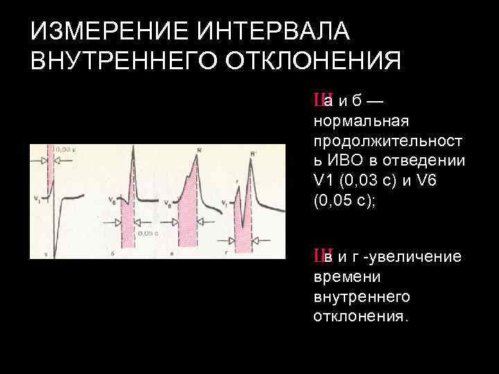 Отклонения на экг. Интервал внутреннего отклонения на ЭКГ. Интервал внутреннего отклонения в v1. Измерение внутреннего отклонения на ЭКГ. Интервал внутреннего отклонения в отведении v1.