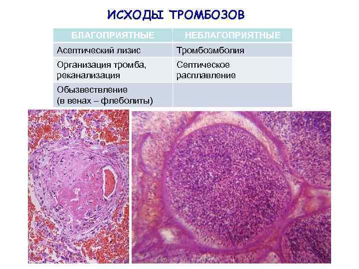 ИСХОДЫ ТРОМБОЗОВ БЛАГОПРИЯТНЫЕ НЕБЛАГОПРИЯТНЫЕ Асептический лизис Тромбоэмболия Организация тромба, реканализация Септическое расплавление Обызвествление (в