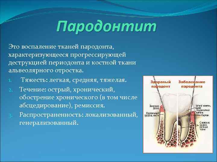 Пародонтит Это воспаление тканей пародонта, характеризующееся прогрессирующей деструкцией периодонта и костной ткани альвеолярного отростка.