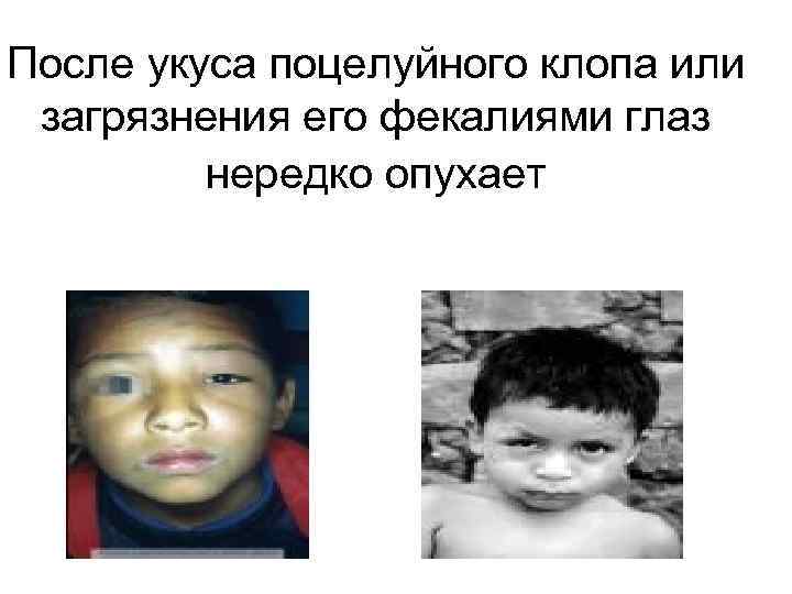 После укуса поцелуйного клопа или загрязнения его фекалиями глаз нередко опухает 