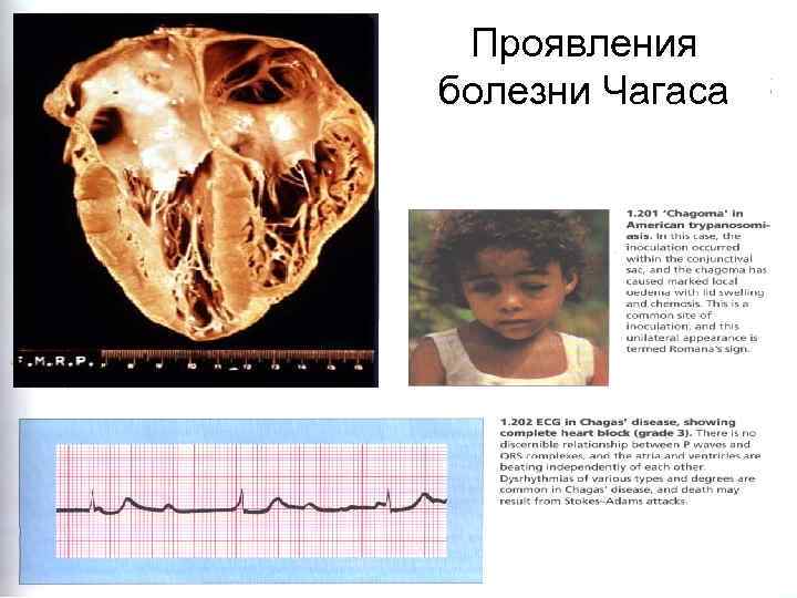 Проявления Symptoms of African and болезни Чагаса American trypanosomiasis 