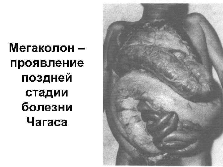 Мегаколон – проявление поздней стадии болезни Чагаса 
