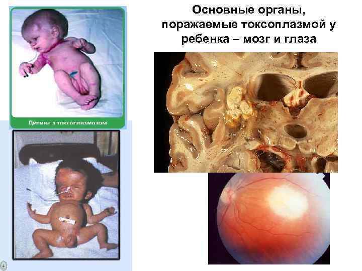 Основные органы, поражаемые токсоплазмой у ребенка – мозг и глаза 