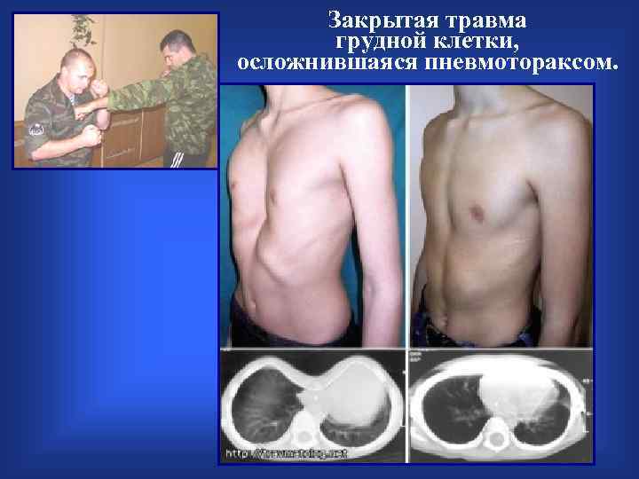 Закрытая травма грудной клетки, осложнившаяся пневмотораксом. 