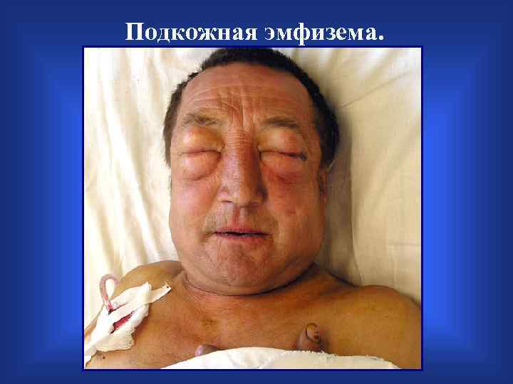 Подкожная эмфизема. 