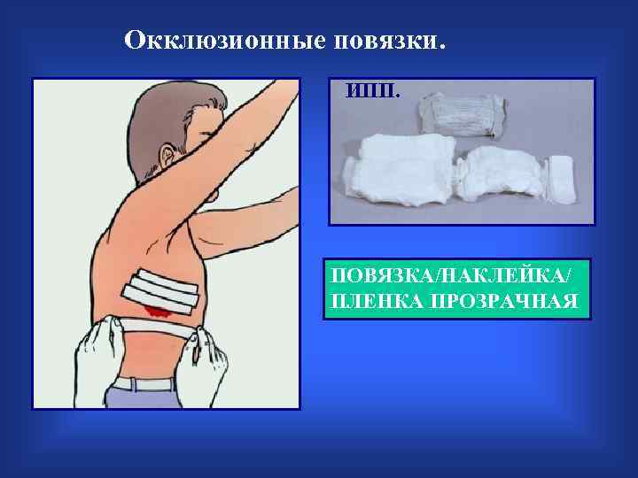 Окклюзионные повязки. ИПП. ПОВЯЗКА/НАКЛЕЙКА/ ПЛЕНКА ПРОЗРАЧНАЯ 