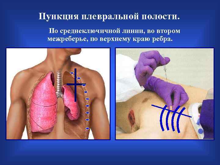 Пункция плевральной полости. По среднеключичной линии, во втором межреберье, по верхнему краю ребра. 