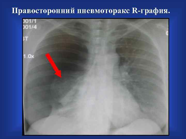 Правосторонний пневмоторакс R-графия. 