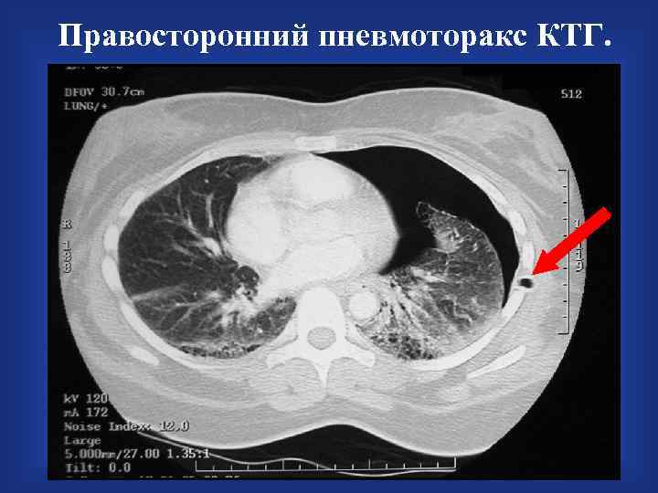 Правосторонний пневмоторакс КТГ. 