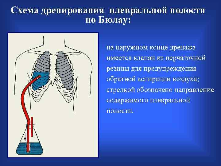 Схема дренирования плевральной полости по Бюлау: на наружном конце дренажа имеется клапан из перчаточной