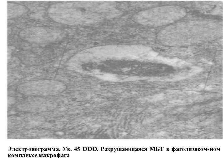 Электронограмма. Ув. 45 ООО. Разрушающаяся МБТ в фаголизосом ном комплексе макрофага 