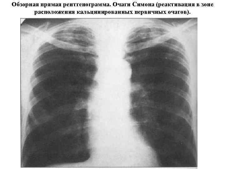Обзорная прямая рентгенограмма. Очаги Симона (реактивация в зоне расположения кальцинированных первичных очагов). 