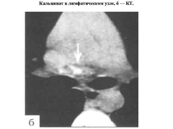 Кальцинат в лимфатическом узле, б — КТ. 