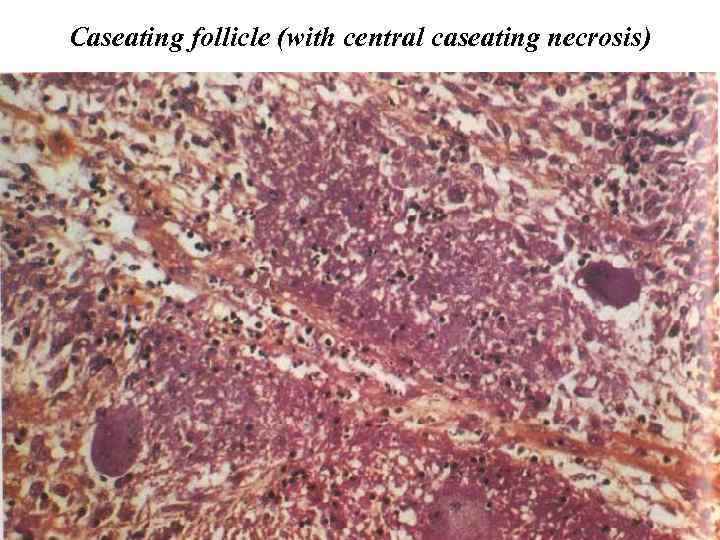 Caseating follicle (with central caseating necrosis) 