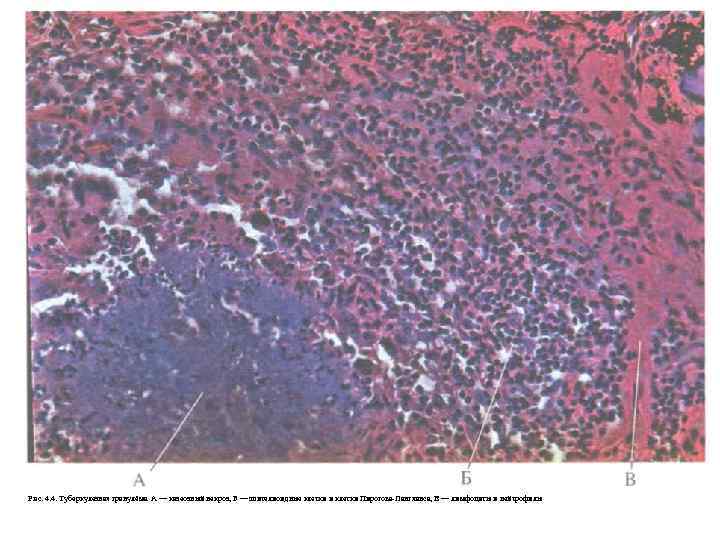 Рис. 4. 4. Туберкулезная гранулёма. А — казеозный некроз, Б — эпителиоидные клетки и