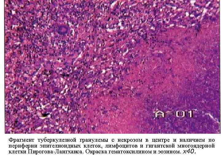 Фрагмент туберкулезной гранулемы с некрозом в центре и наличием по периферии эпителиоидных клеток, лимфоцитов