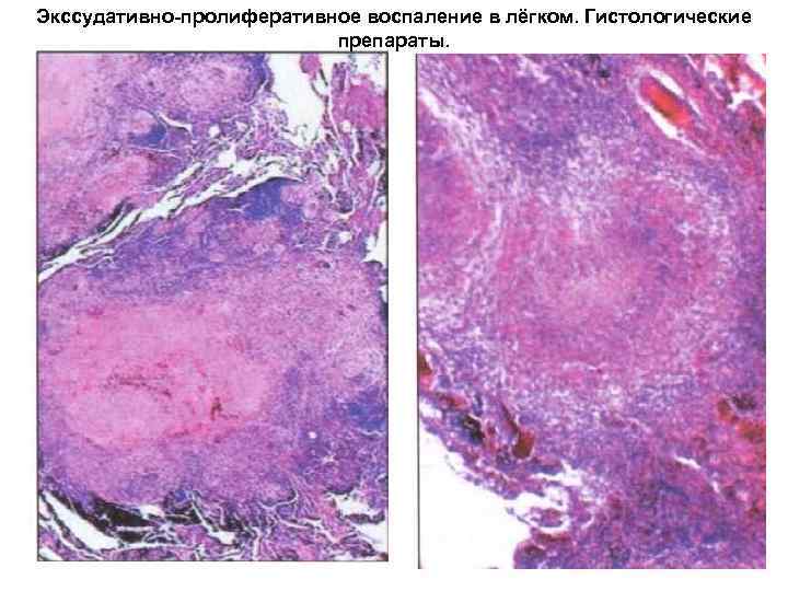 Экссудативно-пролиферативное воспаление в лёгком. Гистологические препараты. 