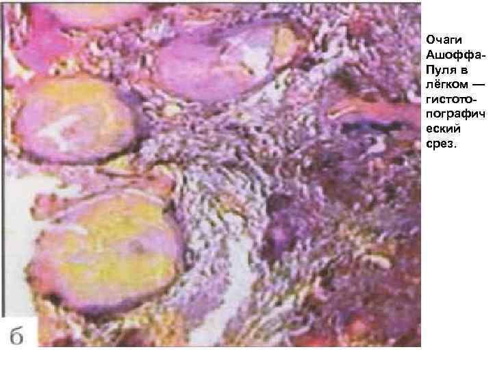 Очаги Ашоффа. Пуля в лёгком — гистотопографич еский срез. 