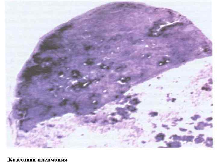. Казеозная пневмония 